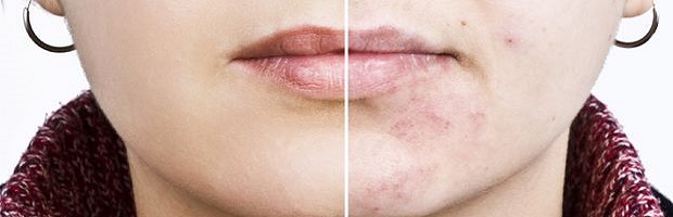 Circunferencia más Goma Como eliminar las cicatrices del acné - Clínica Dermatológica Multilaser
