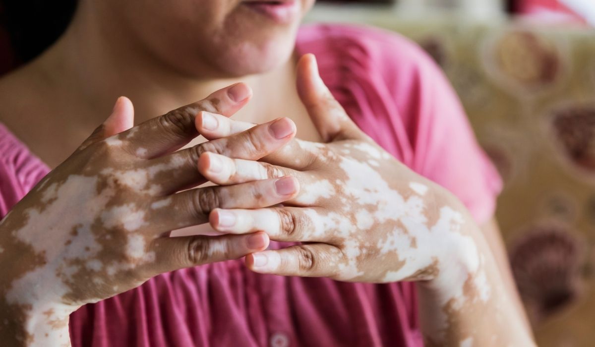 Por qué salen y qué significan las manchas blancas en las uñas  Mejor con  Salud