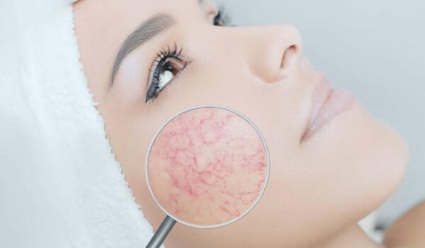 tratar lesiones vasculares
